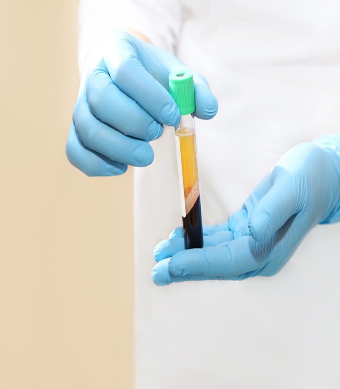 PRP Tratamiento de Plasma Rico en Plaquetas